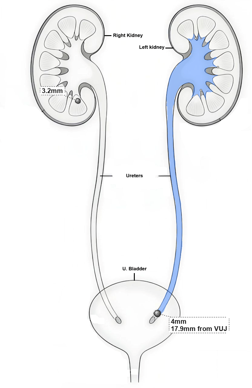 Staghorn Calculus Diagram