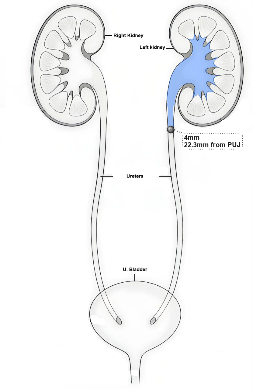 Hydroureteronephrosis Example